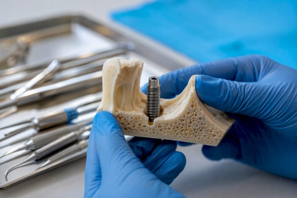 Close-up of titanium dental implant post in jawbone model