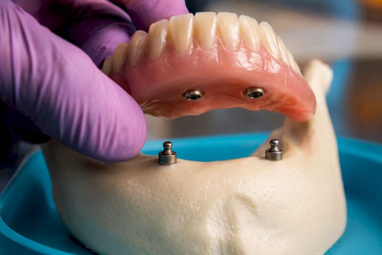 Two Implants Often Best: Snap In Dentures for U.S. Patients