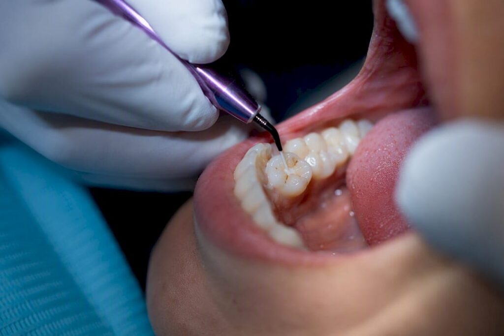 Clinician applying sealant to adult molar